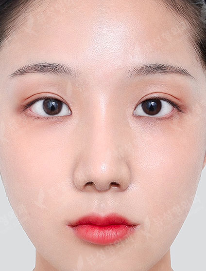 Rhinoplasty + Facial Contouring + Double Eyelid Surgery — After