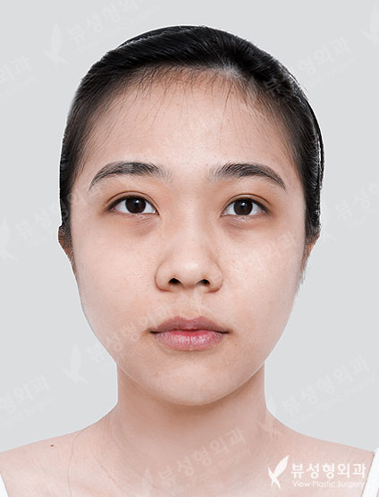 Rhinoplasty + Under Eye Fat Reposition — Before