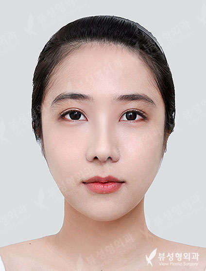 Rhinoplasty + Under Eye Fat Reposition — After