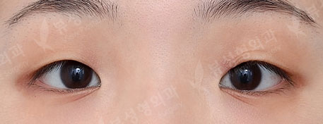 Double Eyelid Surgery + Facial Contouring + Rhinoplasty — Before