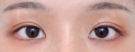 Double Eyelid Surgery + Facial Contouring + Rhinoplasty — After