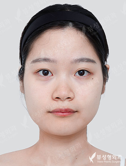 Facial Contouring + Rhinoplasty — Before