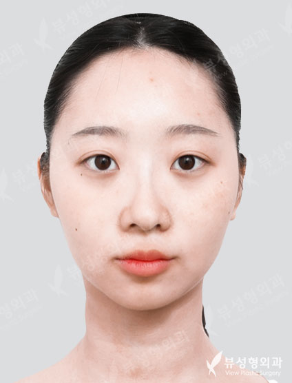 Facial Contouring + Rhinoplasty — Before