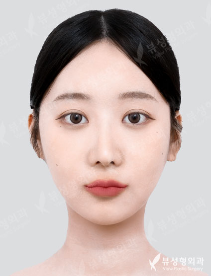 Facial Contouring + Rhinoplasty — After
