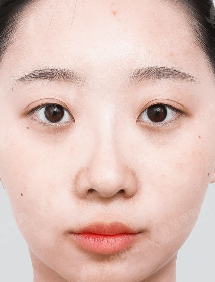 Facial Contouring + Rhinoplasty — Before