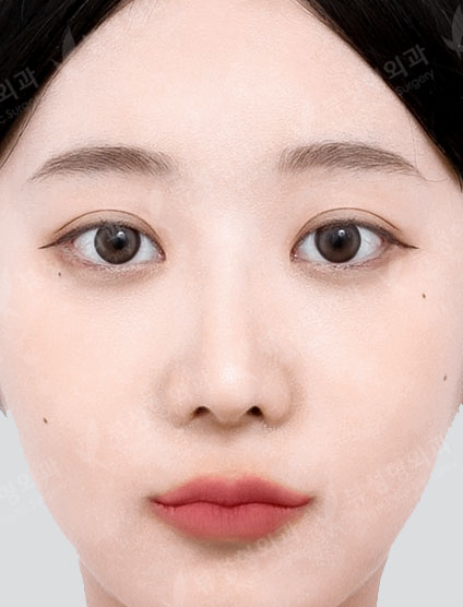 Facial Contouring + Rhinoplasty — After