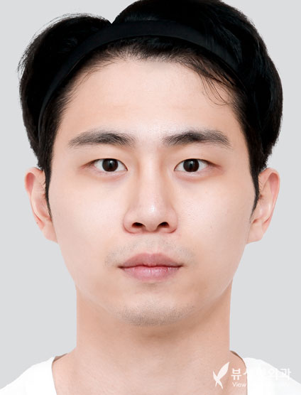 3 Types Facial Contouring + Double Eyelid Surgery + Rhinoplasty — Before