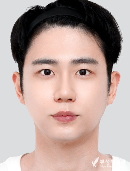 3 Types Facial Contouring + Double Eyelid Surgery + Rhinoplasty — After