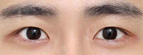 3 Types Facial Contouring + Double Eyelid Surgery + Rhinoplasty — After