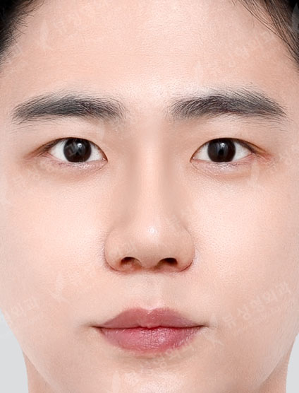 3 Types Facial Contouring + Double Eyelid Surgery + Rhinoplasty — After