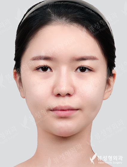 Rhinoplasty + Double Eyelid Surgery + Canthoplasty + Thread lift + Fat Graft — Before