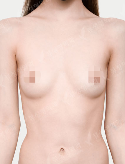 Breast Augmentation (Sebbin) (2Months) — Before