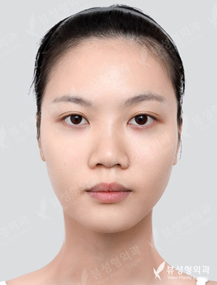 Facial Contouring 3 types + Rhinoplasty (4Months) — Before