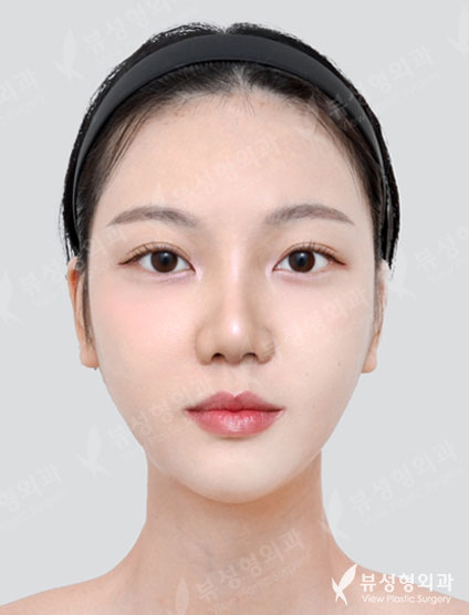 Facial Contouring 3 types + Rhinoplasty (4Months) — After