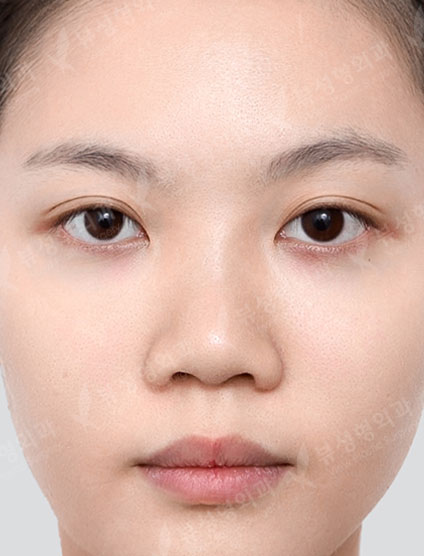 Rhinoplasty (4Months) — Before