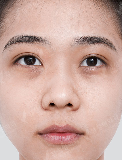 Rhinoplasty + Under Eye Fat Reposition — Before