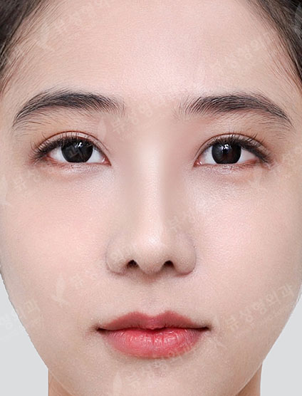 Rhinoplasty + Under Eye Fat Reposition — After