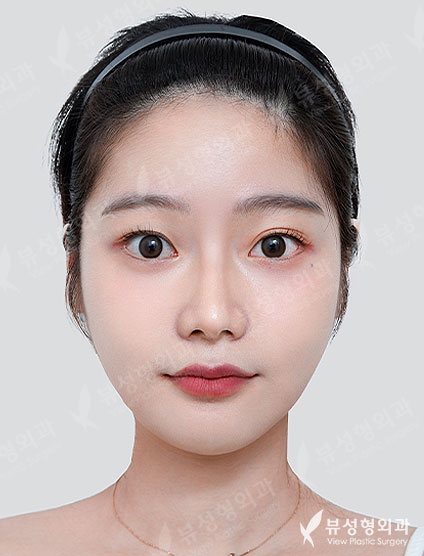 3 Types Facial Contouring + Rhinoplasty — After