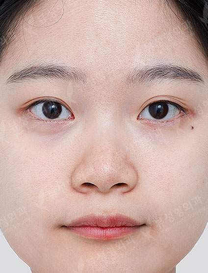 3 Types Facial Contouring + Rhinoplasty — Before