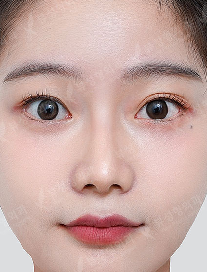 Rhinoplasty + Facial Countouring — After