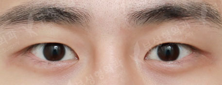 3 Types Facial Contouring + Double Eyelid Surgery + Rhinoplasty — Before