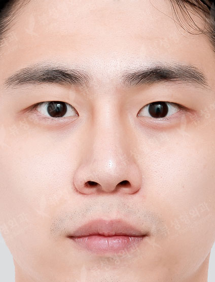 3 Types Facial Contouring + Double Eyelid Surgery + Rhinoplasty — Before