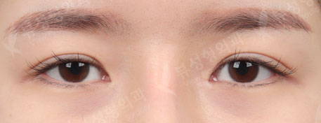 Double Eyelid Revision Surgery + Revision Rhinoplasty + Thread Lift + Fat Graft — Before