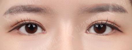Double Eyelid Revision Surgery + Revision Rhinoplasty + Thread Lift + Fat Graft — After