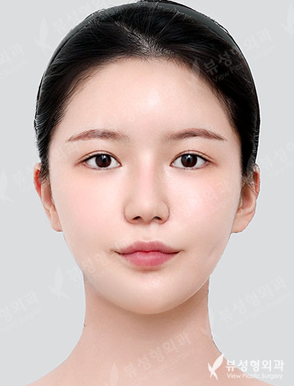 Double Eyelid Revision Surgery + Revision Rhinoplasty + Thread Lift + Fat Graft — After