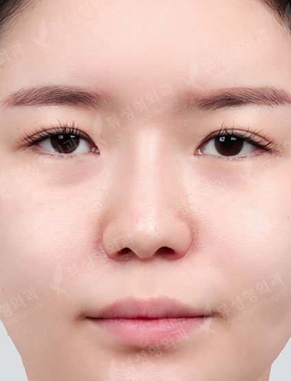 Double Eyelid Revision Surgery + Revision Rhinoplasty + Thread Lift + Fat Graft — Before