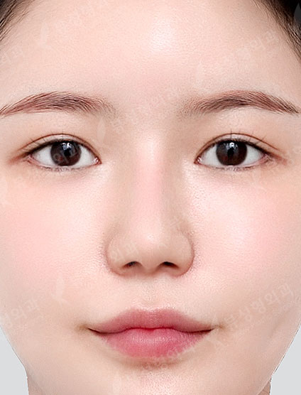 Double Eyelid Revision Surgery + Revision Rhinoplasty + Thread Lift + Fat Graft — After