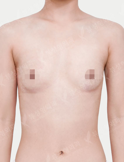 Breast Augmentation (Sebbin) (4 Months) — Before