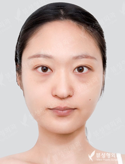 Under Eye Fat Reposition + Rhinoplasty — Before