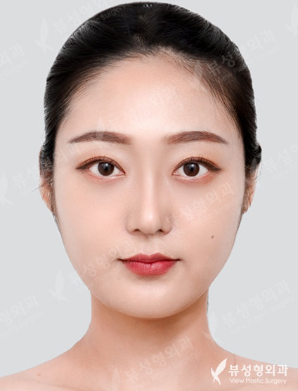 Under Eye Fat Reposition + Rhinoplasty — After