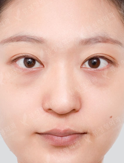 Under Eye Fat Reposition + Rhinoplasty — Before