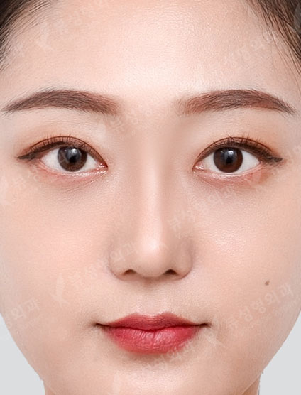 Under Eye Fat Reposition + Rhinoplasty — After