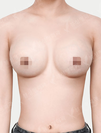 Breast Augmentation (Sebbin) (4Months) — After