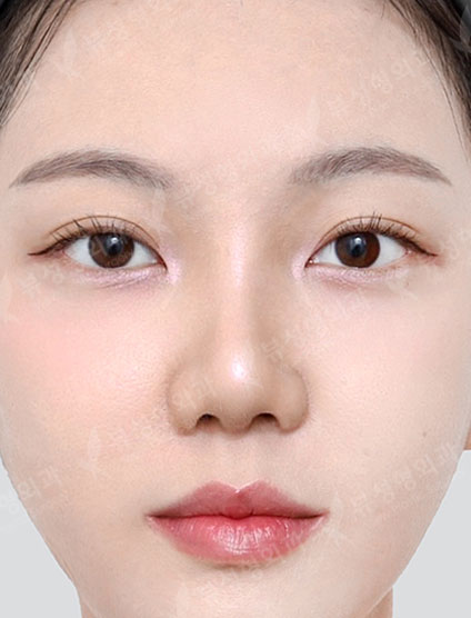 3 Types Facial Contouring + Revision Rhinoplasty — After