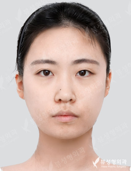 Double Eyelid Surgery + Rhinoplasty + Fat Graft + Face Liposuction + Filler — Before