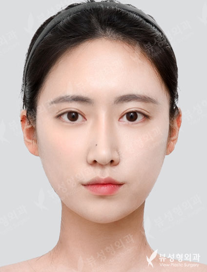 Double Eyelid Surgery + Rhinoplasty + Fat Graft + Face Liposuction + Filler — After