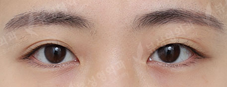 Double Eyelid Surgery + Rhinoplasty + Fat Graft + Face Liposuction + Filler — Before