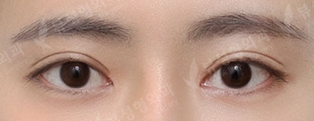 Double Eyelid Surgery + Rhinoplasty + Fat Graft + Face Liposuction + Filler — After