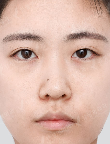 Double Eyelid Surgery + Rhinoplasty + Fat Graft + Face Liposuction + Filler — Before