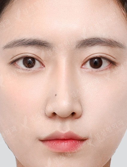 Double Eyelid Surgery + Rhinoplasty + Fat Graft + Face Liposuction + Filler — After