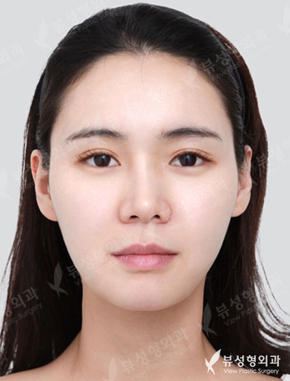 Thread Lift + Fat Graft + Revision Rhinoplasty — Before
