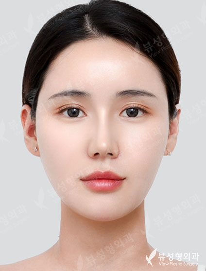 Thread Lift + Fat Graft + Revision Rhinoplasty — After