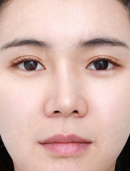 Thread Lift + Fat Graft + Revision Rhinoplasty — Before