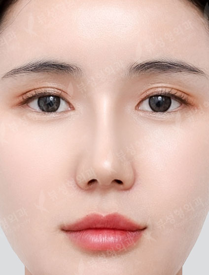 Thread Lift + Fat Graft + Revision Rhinoplasty — After