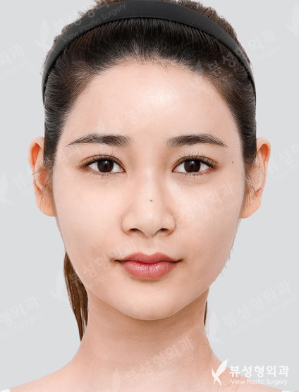 3 Types Facial Contouring + Rhinoplasty — Before