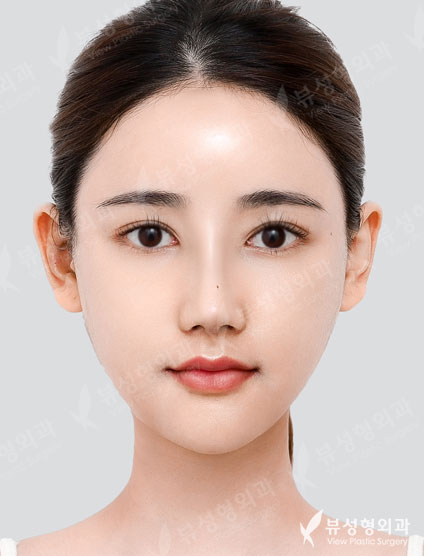 3 Types Facial Contouring + Rhinoplasty — After